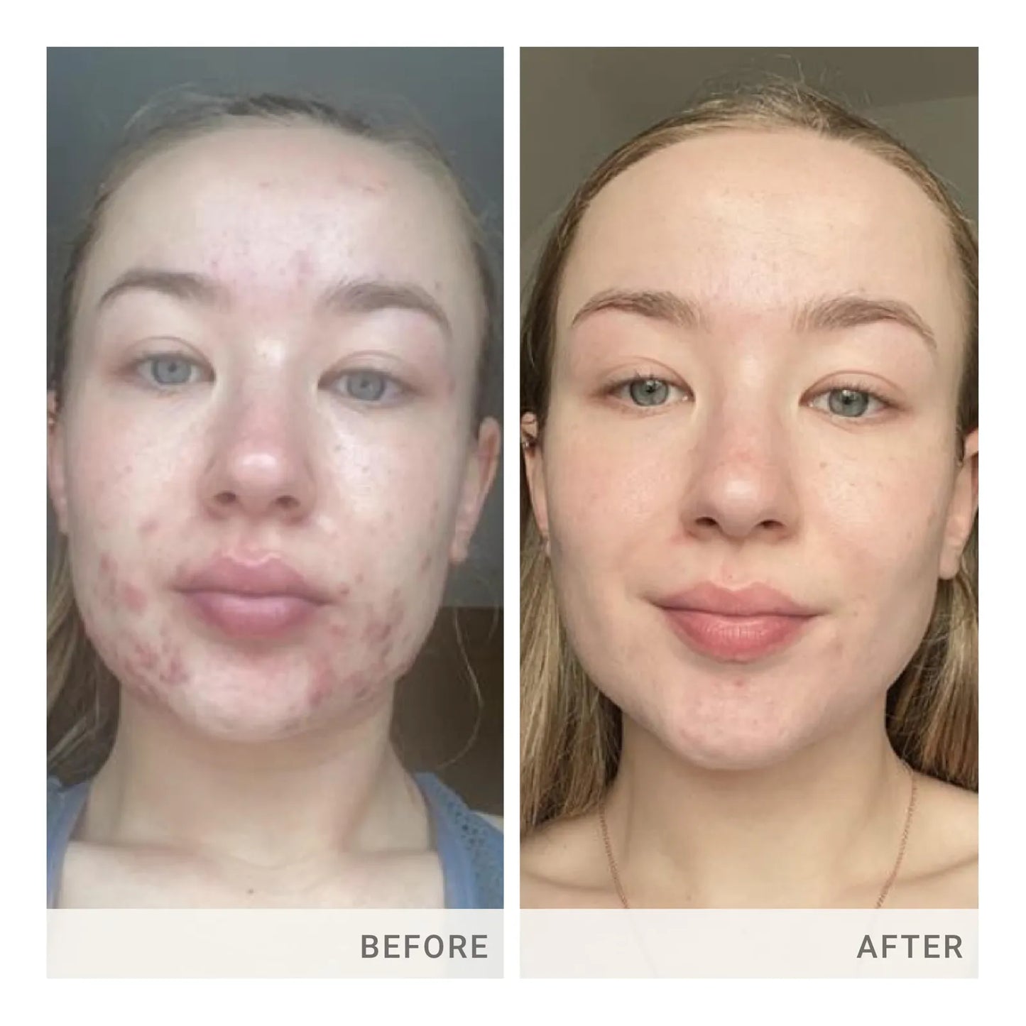 Cápsulas Skin Accumax Mejoran Acné Piel Sana Vitaminas A C E Vegano Sin Gluten