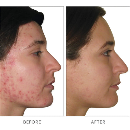 Cápsulas Skin Accumax Mejoran Acné Piel Sana Vitaminas A C E Vegano Sin Gluten