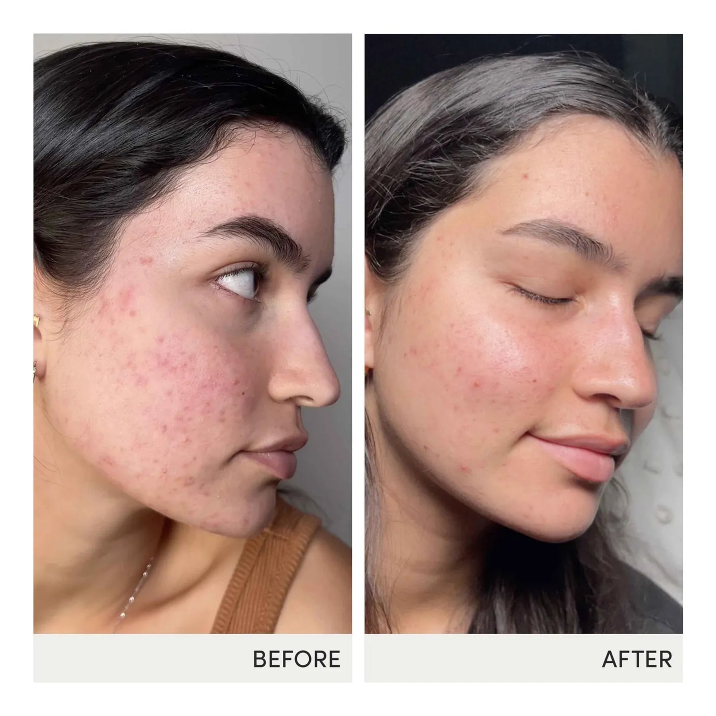 Cápsulas Skin Accumax Mejoran Acné Piel Sana Vitaminas A C E Vegano Sin Gluten